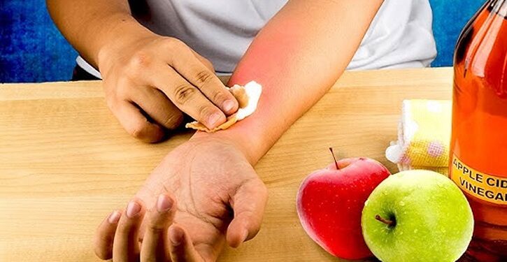 গরমে আংটি-চুড়ি থেকে র্যাশ সারাতে করণীয়