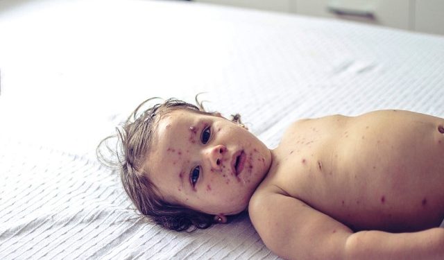 হামের লক্ষণ ও প্রতিকার, যা জানা জরুরি