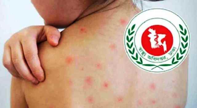 হামের উপসর্গ নিয়ে আরও ৫ শিশুর মৃত্যু
