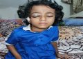 রামুতে প্রবাসী শাহাবুদ্দিনের কন্যা সিএনজির ধাক্কায় আহত