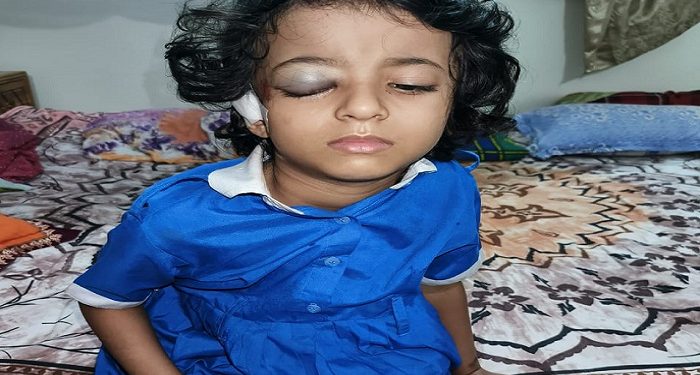 রামুতে প্রবাসী শাহাবুদ্দিনের কন্যা সিএনজির ধাক্কায় আহত