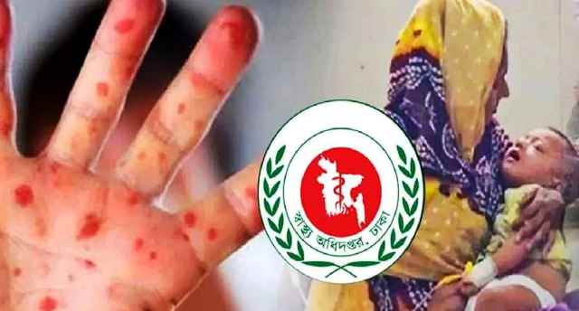 হাম উপসর্গ নিয়ে ২৪ ঘণ্টায় মৃত্যু ৩, আক্রান্ত ১১৩৫